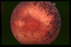 immagine relativa a retina affetta da retinite pigmentosa