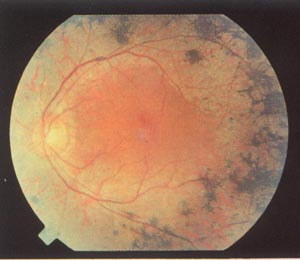 classico fondo oculare di occhio di retinite pigmentosa