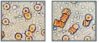 visione al microscopio di componenti sanguigni