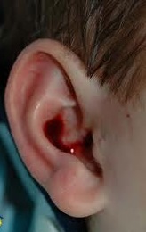 sanguinamento orecchio