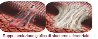 immagine grafica rappresentante sindrome aderenziale