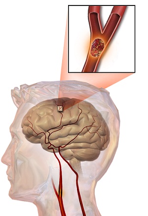 staminali-ictus-cellule