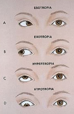 condizione per la quale gli assi visivi non sono allineati