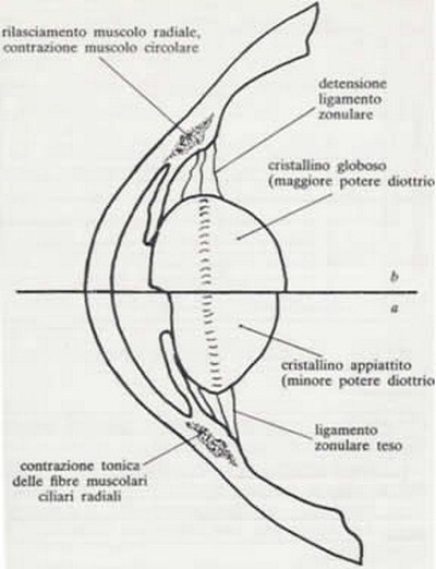 Immagine in cui si evidenzia la differenza strutturale dell'occhio colpito da patologia