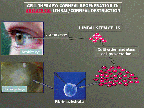 schema in cui viene illustrata la terapia rigenerativa corneale