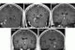 leggi tutto l'articolo L'uomo che ha vissuto per quattro anni con una tenia nel cervello - Corriere della Sera L'uomo che ha vissuto per quattro anni con una tenia nel cervello - Corriere della Sera
