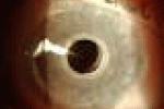 leggi tutto l'articolo Trapianti, impianto cornea artificiale salva l'occhio a un bambino - La Repubblica Trapianti, impianto cornea artificiale salva l'occhio a un bambino - La Repubblica