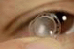 leggi tutto l'articolo Staminali per riparare la cornea: italiano il primo farmaco al mondo - La Repubblica Staminali per riparare la cornea: italiano il primo farmaco al mondo - La Repubblica