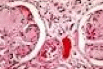 leggi tutto l'articolo L'insulina? Ora si fabbrica con la pelle Passo avanti contro diabete ... - TGCOM L'insulina? Ora si fabbrica con la pelle Passo avanti contro diabete ... - TGCOM