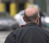 leggi tutto l'articolo Usa, scoperto per caso: il trattamento per l'artrite può curare l'alopecia Usa, scoperto per caso: il trattamento per l'artrite può curare l'alopecia