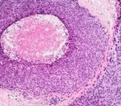 Tumore al seno, una proteina gli fa da scudo e ostacola la progressione