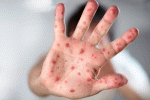 leggi tutto l'articolo Morbillo, 35 morti e 21.325 ammalati in 53 paesi europei: +400% rispetto al 2016, Italia fra i tre paesi più colpiti Morbillo, 35 morti e 21.325 ammalati in 53 paesi europei: +400% rispetto al 2016, Italia fra i tre paesi più colpiti