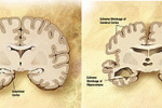 leggi tutto l'articolo Alzheimer, brutte notizie dal fronte ricerca Alzheimer, brutte notizie dal fronte ricerca
