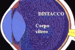 DISTACCO POSTERIORE DI VITREO 