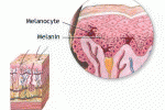 Albinismo Oculare