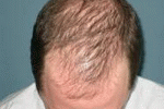 L'alopecia androgenica