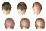 Rivoluzione capelli attraverso cellule clonate