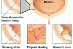 La terapia con cellule staminali mesenchimali allevia la cistite interstiziale