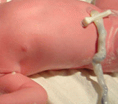 Cordone ombelicale da neonati pretermine: maggior percentuale di progenitori ematopoietici