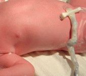 leggi tutto l'articolo Cordone ombelicale da neonati pretermine: maggior percentuale di progenitori ematopoietici Cordone ombelicale da neonati pretermine: maggior percentuale di progenitori ematopoietici