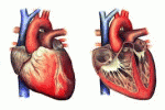 Sangue cordonale e staminali derivate: nuove terapie per la cardiomiopatia dilatativa idiopatica?
