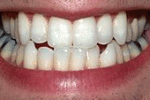 Cos'è lo sbiancamento dei denti?