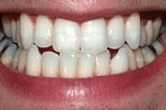 leggi tutto l'articolo Cos'è lo sbiancamento dei denti? Cos'è lo sbiancamento dei denti?