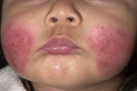 leggi tutto l'articolo Dermatite atopica, trattamento al naturale Dermatite atopica, trattamento al naturale