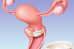 Diaframma come metodo anticoncezionale 