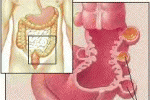 Alimentazione e diverticoli