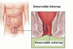 La malattia emorroidaria