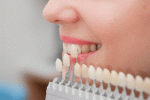 leggi tutto l'articolo Faccette dentali Faccette dentali