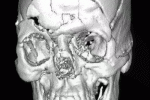 leggi tutto l'articolo Comportamento nella frattura del cranio Comportamento nella frattura del cranio