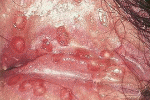 leggi tutto l'articolo Herpes genitale Herpes genitale