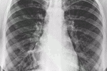 In Italia la polmonite provoca 7mila morti all'anno