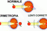 Ipermetropia