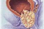 leggi tutto l'articolo Iperplasia prostatica benigna e infiammazione Iperplasia prostatica benigna e infiammazione
