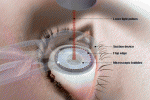 leggi tutto l'articolo LASIK per il trattamento della esotropia accomodativa refrattiva LASIK per il trattamento della esotropia accomodativa refrattiva