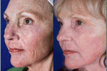 leggi tutto l'articolo Il Laser CO2 per il trattamento chirurgico ambulatoriale per patologie dermatologiche Il Laser CO2 per il trattamento chirurgico ambulatoriale per patologie dermatologiche