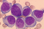 Risultati del trapianto allogenico di staminali ematopoietiche in pazienti adulti con MMLr AML