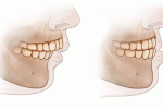 Informazione per i pazienti affetti da Malocclusione 