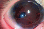 Megalocornea