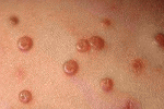 Mollusco contagioso