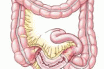 leggi tutto l'articolo Morbo di Crohn e Rettocolite Ulcerosa: nuove possibilità di intervento Morbo di Crohn e Rettocolite Ulcerosa: nuove possibilità di intervento