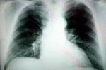 leggi tutto l'articolo Cancro Polmone Cancro Polmone
