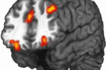 Due protocolli per la riprogrammazione di iPSCs verso neuroni dopaminergici a confronto