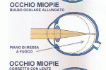 leggi tutto l'articolo Miopia Miopia