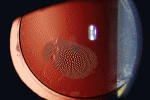 leggi tutto l'articolo Olio di silicone in chirurgia oculare Olio di silicone in chirurgia oculare