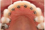 Gli sviluppi dell'ortodonzia linguale: applicazioni e vantaggi