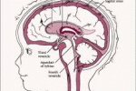 Terapia cellulare per la paralisi cerebrale